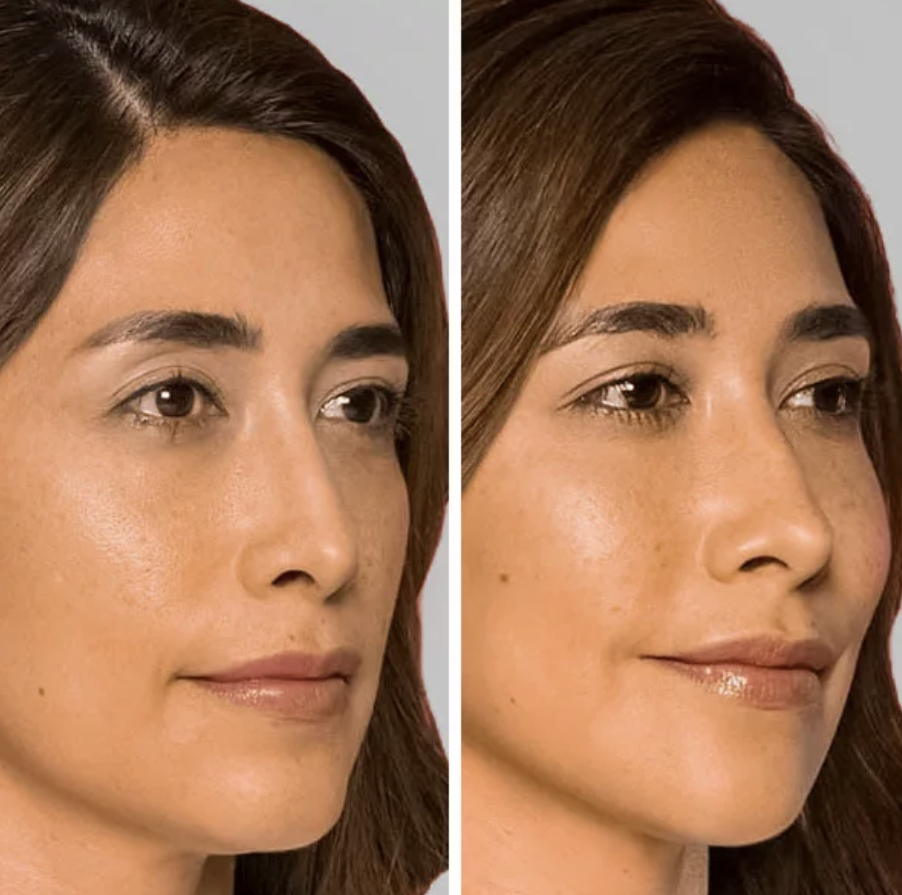 Restylane contour
